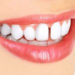 بهترین دندانپزشک اصفهان بستن فضای بین دندان ها