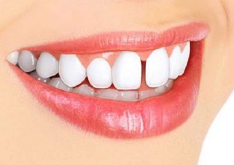 بهترین دندانپزشک اصفهان بستن فضای بین دندان ها