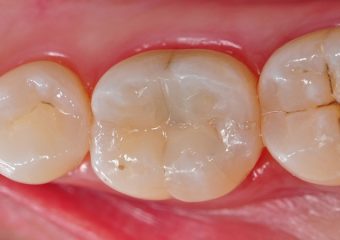 بهترین دندانپزشک اصفهان ترمیم های همرنگ دندان