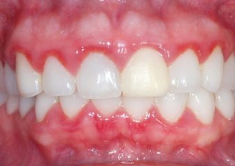 بهترین دندانپزشک اصفهان تغییر رنگ لثه‌ نشانه (نکات مهم)