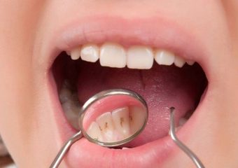 بهترین دندانپزشک اصفهان جرم دندان چیست؟