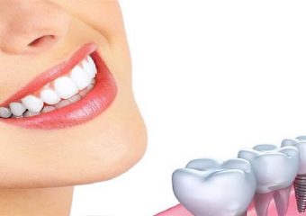 بهترین دندانپزشک اصفهان درباره ایمپلنت و کاشت دندان