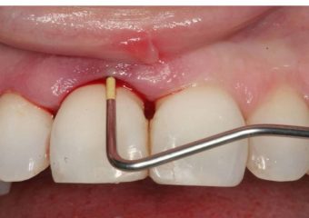 بهترین دندانپزشک اصفهان مراحل جرمگیری دندان