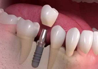 بهترین دندانپزشک اصفهان رایج ترین دلایلی که موجب لق شدن ایمپلنت بعد از سال ها می شود: