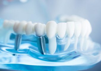 بهترین دندانپزشک اصفهان طول درمان ایمپلنت دندان