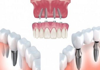 بهترین دندانپزشک اصفهان کاشت ایمپلنت فوری