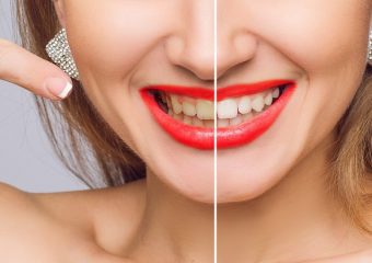 بهترین دندانپزشک اصفهان از جرم گیری و بروساژ بیشتر بدانید !