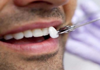 بهترین دندانپزشک اصفهان ونیر کامپوزیت