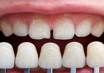 بهترین دندانپزشک اصفهان کاربرد لمینت دندان از زبان دکتر ندا مکانیک