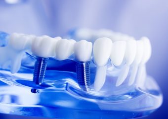 بهترین دندانپزشک اصفهان جلوگیری از لق شدن ایمپلنت