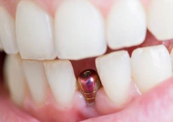 بهترین دندانپزشک اصفهان چگونه لق شدن ایمپلنت را به درستی تشخیص بدهیم؟