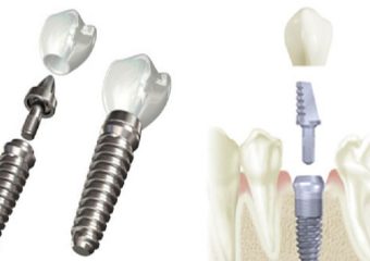 بهترین دندانپزشک اصفهان درمان های احتمالی برای لق شدن ایمپلنت