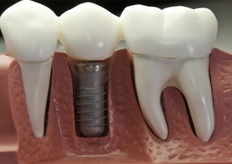 بهترین دندانپزشک اصفهان مشکل لق شدن ایمپلنت
