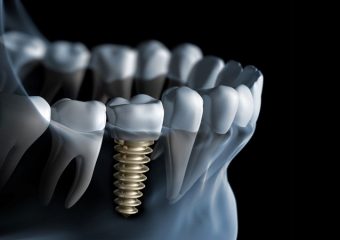 بهترین دندانپزشک اصفهان 7 نکته مهم در رابطه با کاشت دندان و ایمپلنت