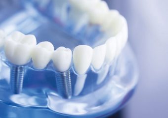 بهترین دندانپزشک اصفهان بهترین دندانپزشک اصفهان چه کسانی می توانند از کاشت ایمپلنت بهره ببرند ؟