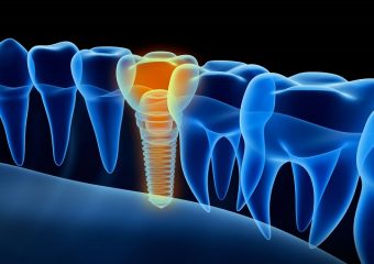 بهترین دندانپزشک اصفهان تحت چه شرایطی کاشت دندان با ایمپلنت انجام می شود ؟