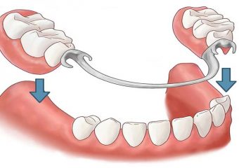 بهترین دندانپزشک اصفهان روش کاشت دندان مصنوعی جزئی قابل برداشتن