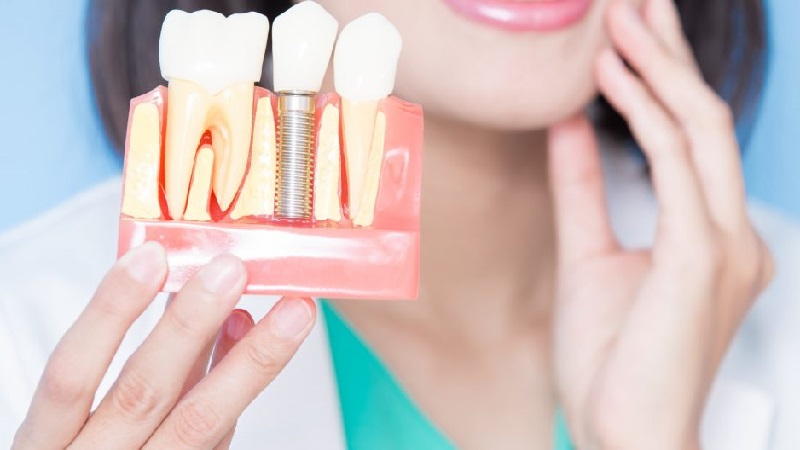 بهترین دندانپزشک اصفهان مدت زمان درمان ایمپلنت دندان چقدر است ؟