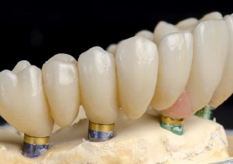 بهترین دندانپزشک اصفهان مزیت های ایمپلنت کامل دندان