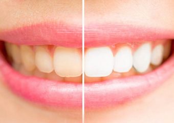 بهترین دندانپزشک اصفهان بلیچینگ دندان