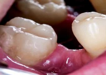 عوارض از دست دادن دندان ها