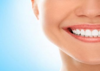 هزینه بلیچینگ دندان