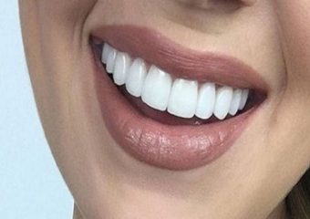 معایب کامپوزیت دندان