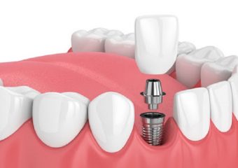 چند نکته مهم در مورد ایمپلنت های دندانی