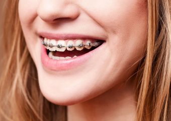 ارتودنسی بهتر است یا لمینیت