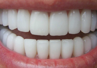 انواع روکش دندان