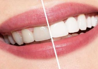 تفاوت بلیچینگ با کامپوزیت ونیر و لمینیت