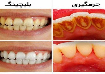 تفاوت جرم گیری با بلیچینگ