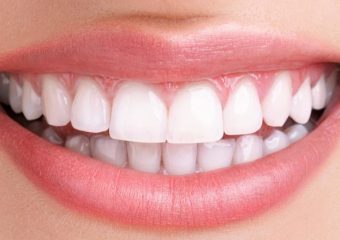 روش های اصلاح طرح لبخند