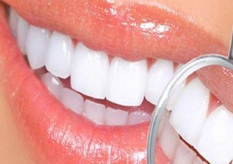 لامینت (ونیر) دندان