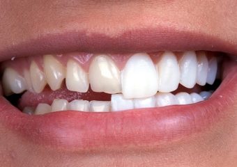 لامینت (ونیر) دندان