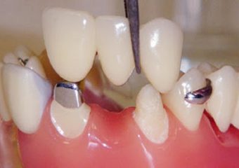 چگونگی کاشت ایمپلنت