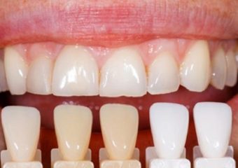 کامپوزیت ونیر