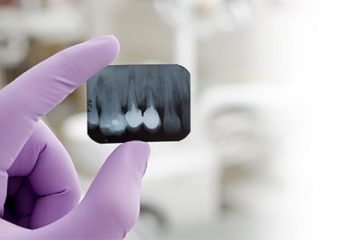 ایمپلنت دندان دائمی