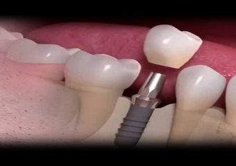 بالا بردن میزان موفقیت درمان ایمپلنت