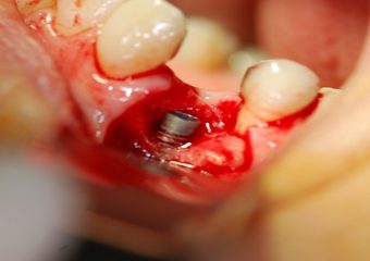 علت بروز بیماری های پری ایمپلنت