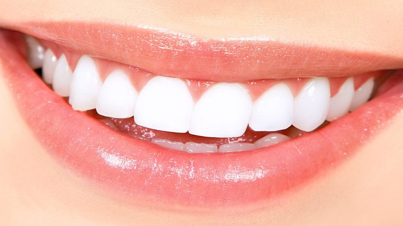 روش انجام لامینت دندان