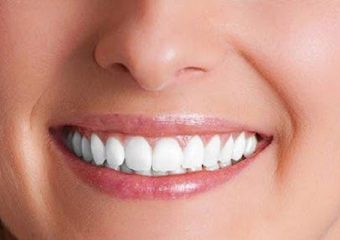 کاندیدای بلیچینگ دندان