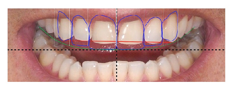 بهترین ایمپلنت اصفهان | ارزیابی طول دندان برای اصلاح طرح لبخند