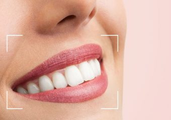 بهترین ایمپلنت اصفهان | بهترین دندانپزشک زیبایی اصفهان | دکتر ندا مکانیک | اطلاعاتی پیرامون اصلاح طرح لبخند