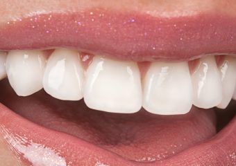 بهترین دندانپزشک اصفهان | انواع لمینت دندان