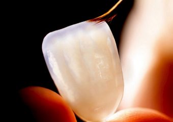 بهترین دندانپزشک اصفهان | ماندگاری لمینت دندان چقدر است ؟