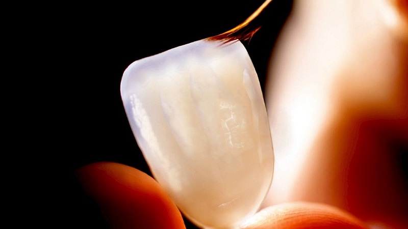 بهترین دندانپزشک اصفهان | ماندگاری لمینت دندان چقدر است ؟