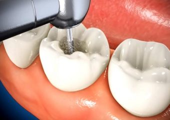 بهترین دندانپزشک اصفهان | چه موقع به انجام عصب کشی دندان نیاز پیدا خواهیم کرد؟