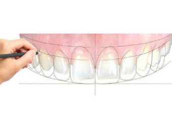 بهترین دندانپزشک اصفهان | اصلاح نواقص با استفاده از طراحی لبخند