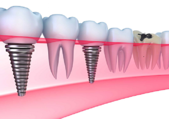 بهترین ایمپلنت اصفهان | ایمپلنت فوری